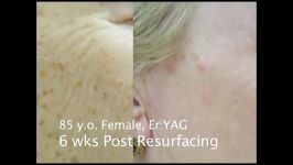 Erbium Laser Resurfacing Before and After Phots