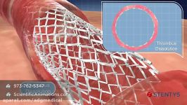 3D Animation of Coronary Stent Procedure