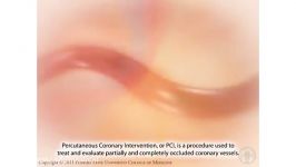 Percutaneous Coronary Intervention Coronary Angioplast