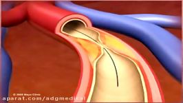 ANGIOPLASTY and STENTING