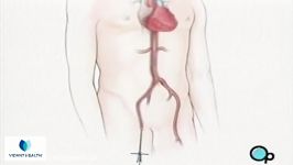 Stent Implantation Coronary Angioplasty