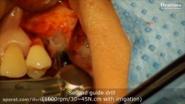 Sinus elevation with emplantation