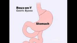 Roux en Y Gastric Bypass