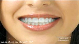 Orthosmile  Clear Retainer