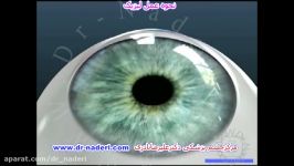 عمل جراحی لیزیک  مرکز چشم پزشکی دکتر علیرضا نادری