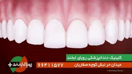 ایمپلنت دندانی، دندانی برای همیشه