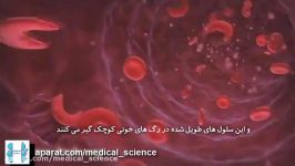 کم خونی داسی شکل Sickle Cell Anemia