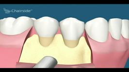 جراحی لثه کلینیک دندانپزشکی فرایش