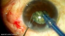 Hrad cataract phaco using Pulsar 2 from optikon