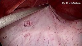 Salpingo Oophorectomy for Large Ovarian Cyst  YouTube