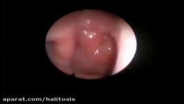 لارنگوسکوپی حنجره قابل انعطاف flexible laryngoscopy