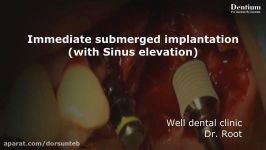 Sinus elevation with implantation thin out technique