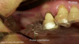 Sinus elevation with implantation wall off technique