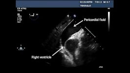 emergency pericardiocentesis