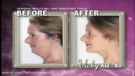 دستگاه برطرف کننده غبغب neckline slimmer