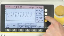 medinCNO® ventilation modes SNIPPV