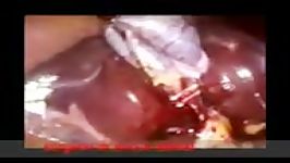 laparoscopic cholecystectomy# #لاپراسکوپی کیسه صفرا