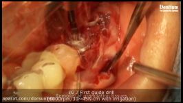 Contour augmentation with installation on mandible