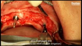 G.B.R on maxillary edentulous case