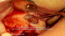 Management of periodontal bone defect with simultaneous