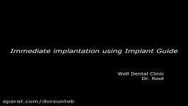 Immediate implantation using Implant Guide1