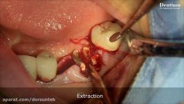 Immediate implantation using Implant Guide2