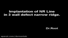 Implantation Of NR Line in 3 Wall defect narrow Ridge