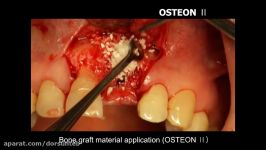 OSTEON II Collagen membrane