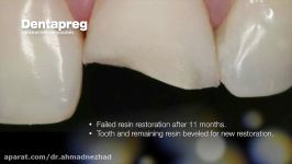 افزایش استحکام ترمیم کامپوزیت دندانهای قدامی نوارUFM