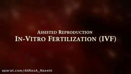 لقاح مصنوعی یا IVF