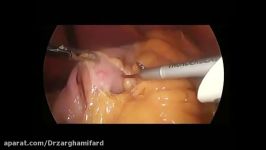 sleeve gastrectomy اسلیو معده دکتر زهره ضرغامی فرد