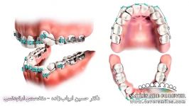 ارتودنسی نامرتبی دندان ها  دکتر حسین ارباب زاده