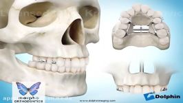 surgically assisted rapid palatal expansion