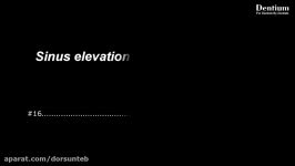 Sinus Elevation Using Sinus Elevator