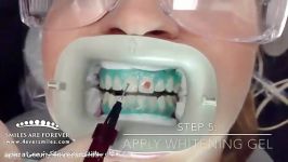 سفید کردن دندان بلیچینگ  دکتر نهال سناوندی