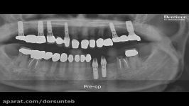 Immediate implantation using Implant Guide