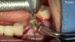 Immediate implantation using Implant Guide II