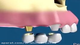بریج بر پایه ایمپلنت دندان