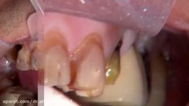 بازسازی دندانهای قدامی فک بالا پروتزهای IPS e.max