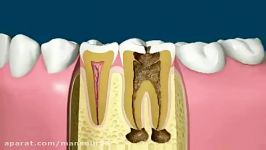 کلیپ طریقه عصب کشی روکش کردن دندان ها