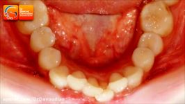قبل بعد ارتودنسی نامرتبی دندانهای پایین دکترداودیان