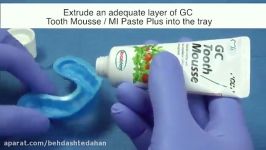 نحوه استفاده خمیر مکمل کلسیم فسفر GC Toothmousse