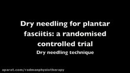 استفاده طب سوزنی dry needling در درمان خار پاشنه