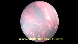 جراحی ترانس آندوسکوپیک رکتوم توسط دکتر شهرام نظریShahramnazari.com