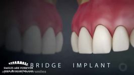 مقایسه ایمپلنت بریج دندان