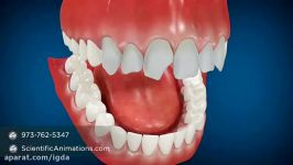 implant versus dental bridge