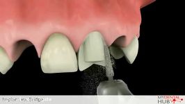 Implant versus Dental Bridge