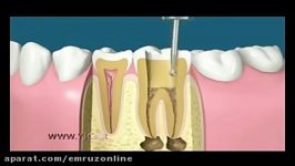 مراحل جالب عصب کشی روکش کردن دندان