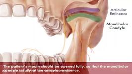 Gow Gates Nerve Block Using Extra oral Landmarks