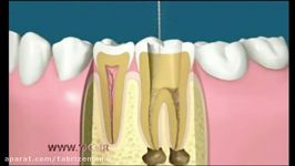 ویدئوی جالب عصب کشى روکش کردن دندان